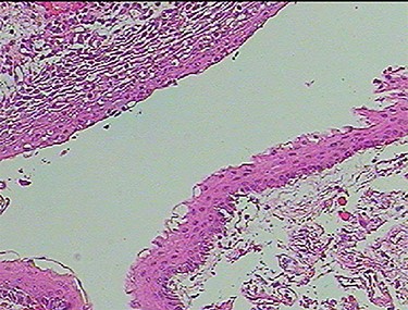 Photomicrograph of the biopsy specimen, showing that the tissue sample presents a cystic structure, packed with laminated keratin. Multilayered squamous epithelia are stratified on the cyst wall. No skin appendages are observed (hematoxylin and eosin, ×40).