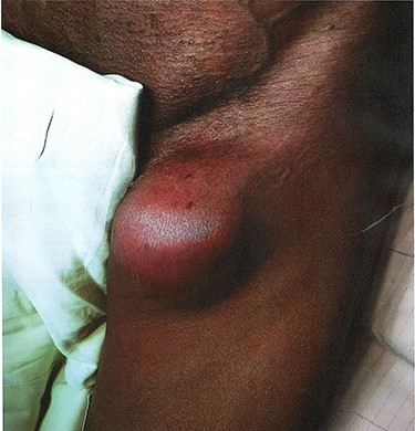 Haematoma of the left thigh.