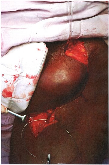 Control over the common femoral artery and SFA.