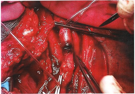Contusion of SFA with thrombosis.