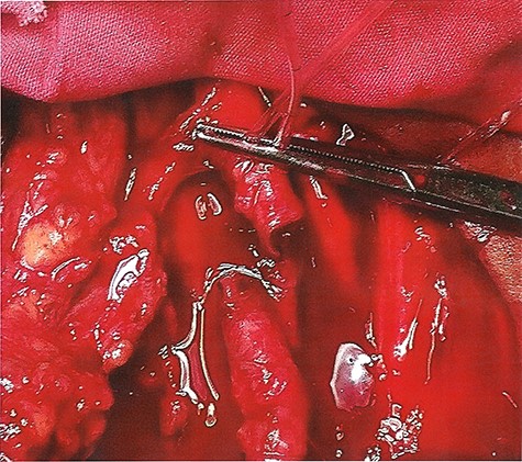 SFA is transected; a thrombus is seen inside the artery.