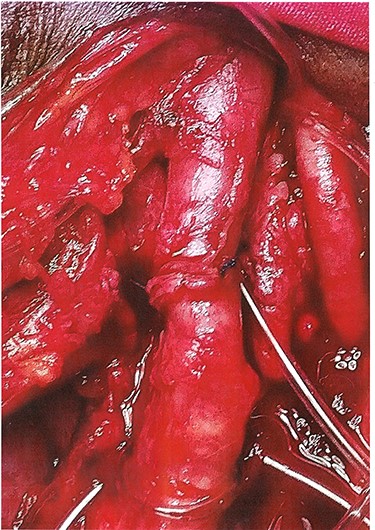 Anastomosis completed.