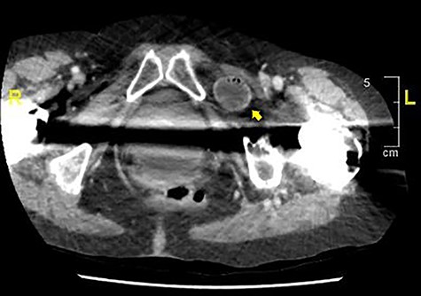 Axial section demonstrating small bowel loops in left obturator space.