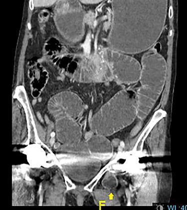 Distended stomach and dilated bowel loops with an obturator hernia (pointed by the arrow), as shown in the coronal section.