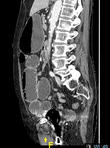 Distended stomach and dilated bowel loops with an obturator hernia (pointed by the arrow), as shown in the sagittal section.