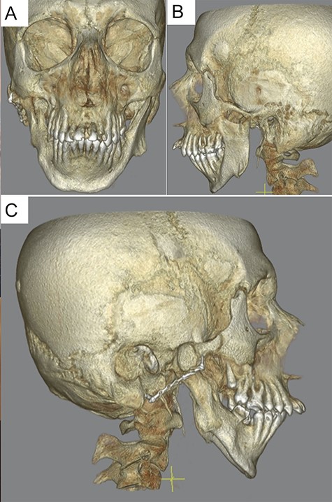 Preoperative computed tomography after initial presentation with a presentation of the bilateral deforming arthrosis of the temporomandibular joint.