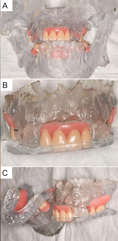 Patient 3D model with an integrated prosthesis in the upper and lower jaw as well as an intermediate and final occlusal splint.