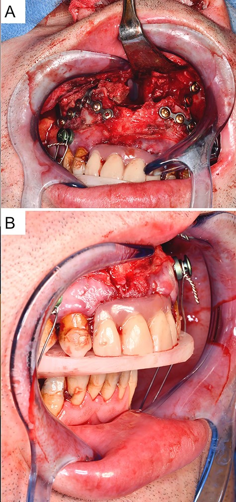 Intraoperative situation with (A) presentation of the osteosynthetically fixed interposition osteoplasty in the maxilla after LeFort-I-osteotomy and advancement of the maxilla, and (B) intermediate position after advancement of the maxilla with an intermediate splint and rigid intermaxillary fixation.