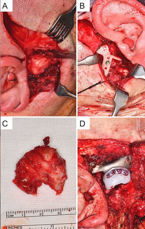 Intraoperative situation with (A) exposed view of the ankylosed deformed temporomandibular joint on the right via a preauricular approach, (B) shows the inserted resection template on the left, (C) resected ankylotic mass, (D) osteosynthetically fixed fossa component on the right (Zimmer Biomet Holdings, Warsaw, IN, USA).