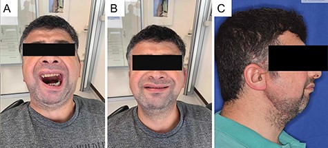 Clinical situation 6 months after surgery with increased mouth opening with integrated prostheses in the upper and lower jaw and overall improved general health condition.