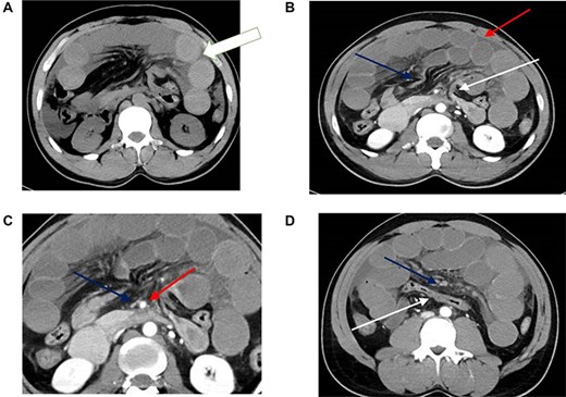 CT scan findings of transmesocolic hernia. (A) CT scan demonstrates hyperdense appearance of small bowel loops (arrow) suggestive of intramural hemorrhage. (B) Contrast enhanced CT scan demonstrates internal hernia with dilated bowel loops (red arrow), afferent loop at dudenojejunal junction (white arrow) and efferent loop (blue arrow). There is associated mesenteric congestion and free fluid. (C) Marked attenuation of the superior mesenteric vein (blue arrow) compared to the adjacent superior mesenteric artery (red arrow). Note also the congestion and fan-like. (D) The transverse colon (white arrow) is seen posteriorly with the congested small bowel mesentry (blue arrow) and dilated small bowel loops seen anterior to it. Note also the poor enhancement of the mesenteric veins.