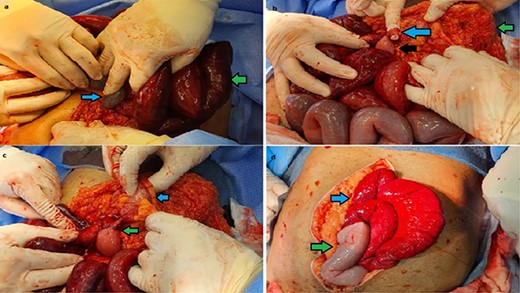 Intra-operative findings of transmesocolic hernia. (A) blue arrow: mesenteric defect with small bowel; green arrow: congested, near ischemic bowel. (B) green arrow: transverse colon; blue arrow: adhesive band; black arrow: small bowel protruding through transverse colon mesenteric defect. (C) blue arrow: transverse colon; green arrow: retrieved small bowel herniated through the mesenteric defect. (D) post closure of defect; green arrow: small bowel regaining normal color; blue arrow: hyperemic small bowel.