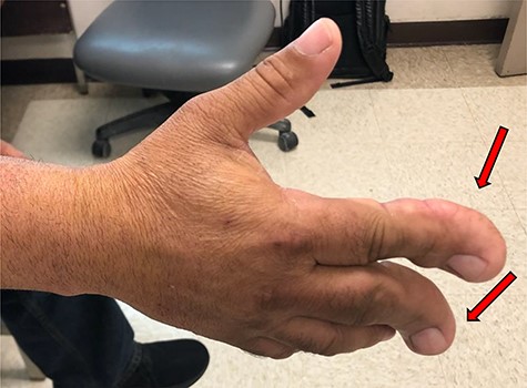 Clinical photographs of a Hispanic adult with macrodactyly and Lipofibromatous Hamartoma (red arrow).