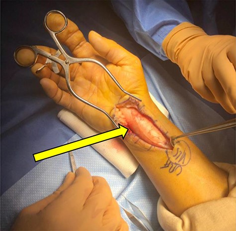 Intraoperative photographs of a Hispanic adult with lipofibromatous hamartoma (yellow arrow).