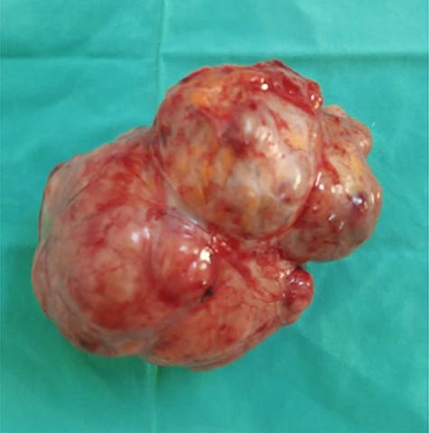 Well defined lobulated and encapsulated mass weighing ~500 g and measuring 12.5 × 10.5 × 8 cm dimensions.