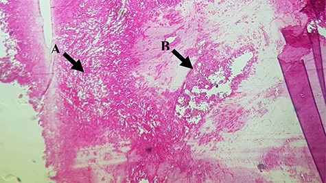 (A) Moderately polymorphic spindle-shaped cells with elongated moderately pleomorphic and hyperchromatic nuclei and low mitotic activity; (B) Note some layers of atypical mesothelial cells.
