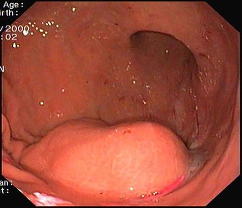 Upper gastrointestinal endoscopy: 4 cm subepithelial lesion located at gastric antrum.