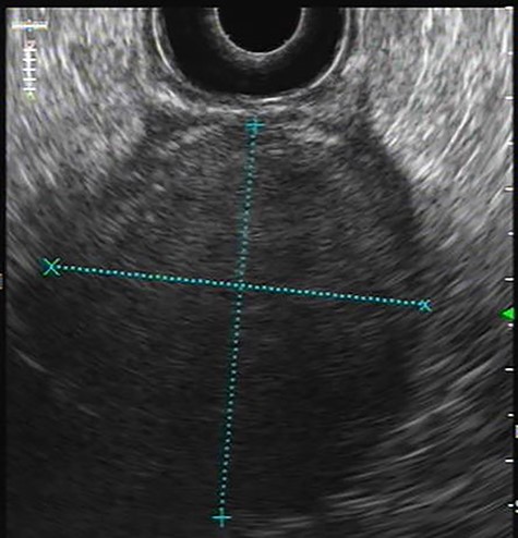 Endoscopic ultrasonography: Hypoechoic homogeneous lesion, growing on the 4th layer of gastric wall with regular contours, well-defined limits and negative Doppler sign; no cystic aspects were found; gastrointestinal stromal tumour diagnosis was suggested.