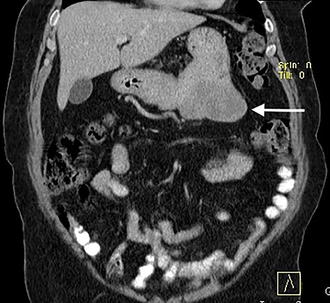 Computed tomography contrast-enhanced scan: predominantly exophytic neoplasm growing from gastric greater curvature (arrow) with 97 × 77 × 57 mm; no signs of metastatic or locally advanced disease were found.