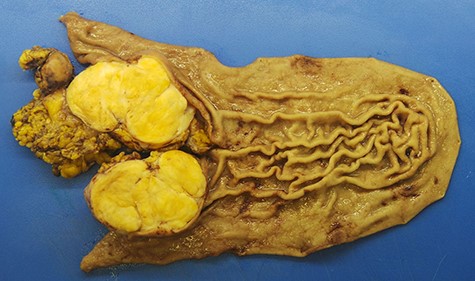 Surgical specimen, gastric schwannoma: intramural, nodular, solid mass measuring 85 × 60 × 60 mm. A cross-section revealed a yellowish homogeneous tumour, well-delimited though not capsulated.