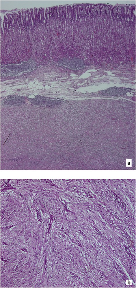Histological findings, gastric schwannoma: a. Muscularis propria tumour, surrounded by peripheral lymphoid aggregates (Hematoxylin and eosin, x20). b. Spindle cells with palisading nuclei, arranged in a fascicular pattern with rare mitosis (1/30 high-power field) and no necrosis (Hematoxylin and eosin, x100).