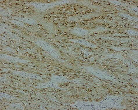 Immunohistochemistry, gastric schwannoma: Tumour cells with strongly positive nuclear staining for S-100 (S-100, x100).