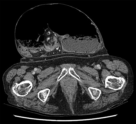 Caecal volvulus, showing distended caecum within ventral hernia showing mesenteric swirling (axial).