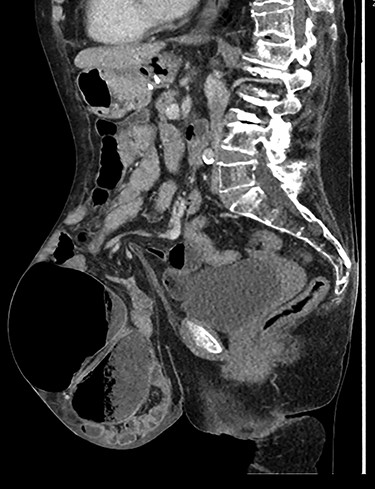 Caecal volvulus through wide-necked abdominal wall defect with small amount of free fluid in pelvis (sagittal).