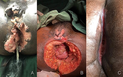 Cantrell syndrome at presentation (A), after the surgery procedure (B) and after 4 months from treatment (C).