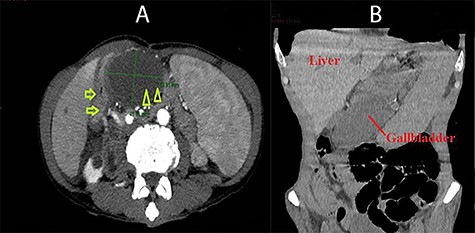 Abdominal CT images: A (axial view): duodenum (arrow) and the gallbladder located on the left of the duodenum and posterior to the stomach (arrow head); B (coronal view): the gallbladder was situated under the stomach and far from the gallbladder bed.