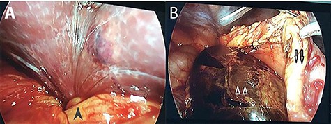 Intra-operative photographs: A: the torsion point at the gallbladder infundibulum (black arrow head); B: necrotic gall bladder (white arrow heads) located posterior to the stomach (black arrows).