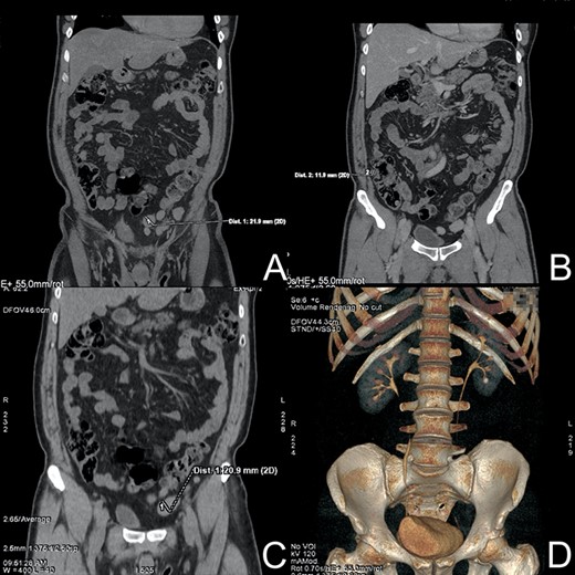 CT-urography. (A) Enlarged lymph node near sigmoid colon. (B) Pathological lymph node near the ascending colon. (C) Low-dose CT without contrast—lymph node. (D) 9 mm stone in the lower calyx of the left kidney.