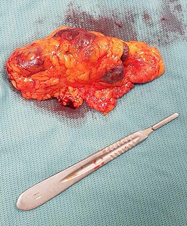 The conglomerate of tuberous lesions with a fragment of a greater omentum.