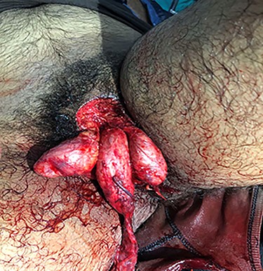 Complete degloving of penile shaft and scrotum.