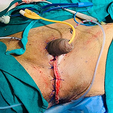 Both the Testes buried in the medial thigh forming a medial thigh pocket and penile shaft sutured with the abdominal skin.