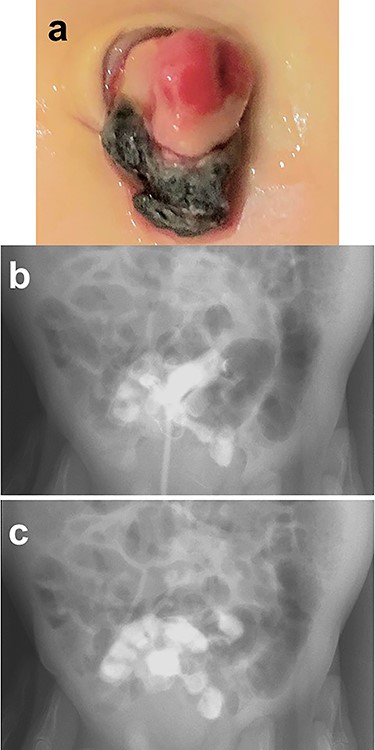Physical findings on outpatient consultation and trans-stomal fistulography. (a) There appears to be a small stoma present after ligation of the umbilical cord. (b and c) Contrast media, injected through a catheter inserted into the stoma, enters the lumen of the small bowel.