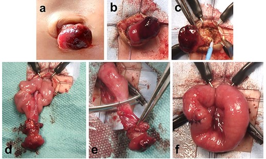 Resection of a patent omphalomesenteric duct using an intraumbilical round incision. (a–c) The communication between the stoma and the intra-abdominal intestine is cored out from the anterior abdominal wall through an intraumbilical round incision. (d) Part of the communication between the patent omphalomesenteric duct and intestine is removed through the intraumbilical incision. (e and f) The patent omphalomesenteric duct is completely resected, and the cut edge is closed using absorbable sutures.