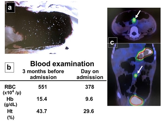 Patient workup. (a) Photograph after an episode of bloody stool was noted in the diaper. (b) Bloodwork performed 3 months before admission was normal, while laboratory investigation on the day of assessment reveals new-onset anemia. (c) Nuclear imaging using 99m technetium pertechnetate reveals a small, round area of intense tracer activity in the midabdomen.
