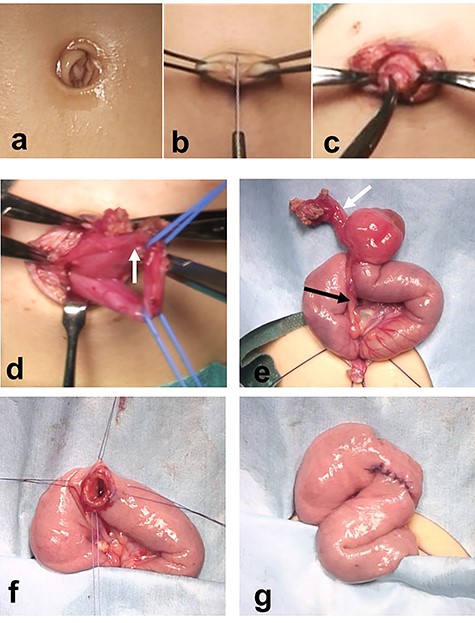 Resection of a Meckel diverticulum connected to the umbilicus by a fibrous cord using a transumbilical vertical incision. (a-c) The umbilicus is divided vertically to create a pair of laterally based skin flaps. The subcutaneous tissue is cored out from the anterior abdominal wall through the umbilical incision. (d) A fibrous cord connected to a Meckel diverticulum and a urachal remnant (white arrow) is seen. (e) The blood vessel supplying the Meckel diverticulum is divided and ligated. (f and g) Limited segmental resection including the Meckel diverticulum and the fistula is completed. The cut edge is closed using absorbable sutures.