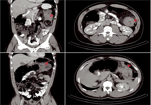 CT appearance of colonic intussusception (arrows) in the left upper quadrant secondary to colonic mass.
