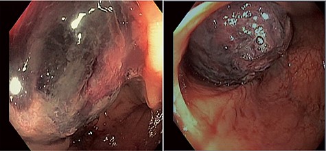 Colonoscopic images of the colonic intussusceptum with an ischemic, dusky mass lead point secondary to mucosal edema and venous congestion.