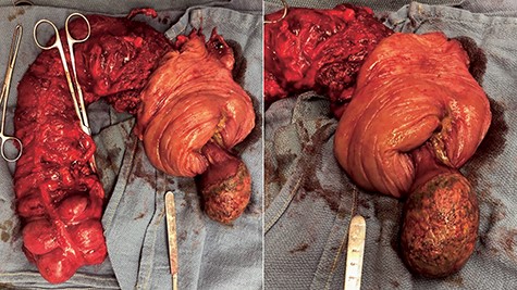 Gross appearance of resected colon showing giant lipoma.