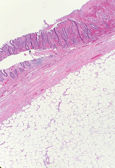 Hematoxylin and eosin (H&E) staining of colonic specimen revealing a submucosal lipoma.