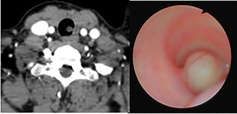 (A) CT scan showing an endotracheal tumor at the left posterior tracheal wall; (B) bronchoscopy view showing partial airway obstruction caused by the tumor.