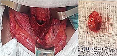 (A) Anterior tracheotomy at the fourth tracheal ring; (B) gross resection specimen.