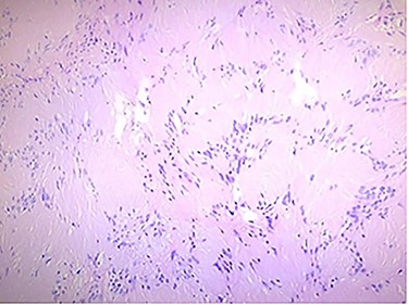 Histologic findings: the tumor was formed by spindle cells with elongated palisading nuclei; hematoxylin and eosin stain.