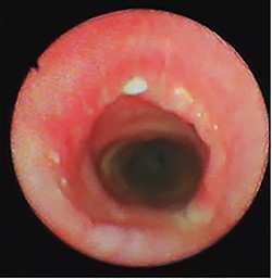 Bronchoscopy view at the tumoral resection site after 4 weeks from surgery.