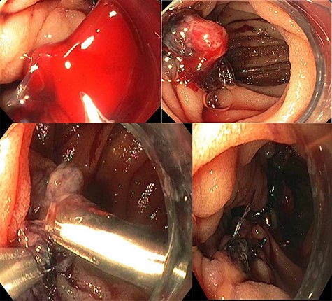 The bleeding jejunum ulcer proximal to the anastomosis with an adherent clot near the site of anastomosis.