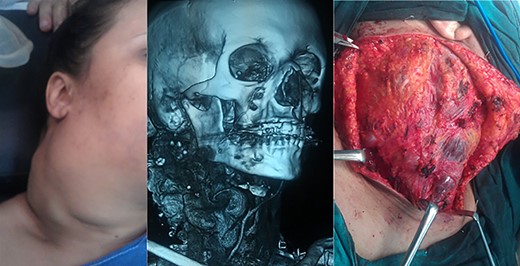 Patient #1 before surgery, magnetic resonance imaging, during surgery.