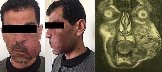 Patient #2 before surgery.